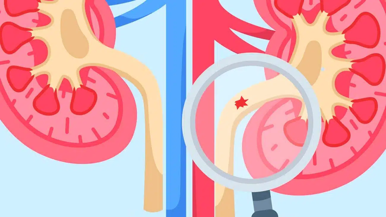 How to Pass a Kidney Stone