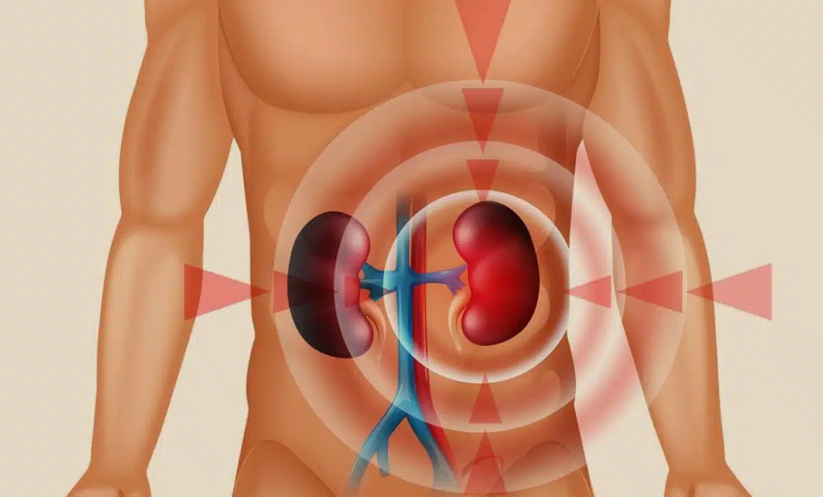 Will My Kidney Stone Pass?