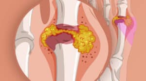 Gout and Kidney Stones: Uric Acid and What to Eat