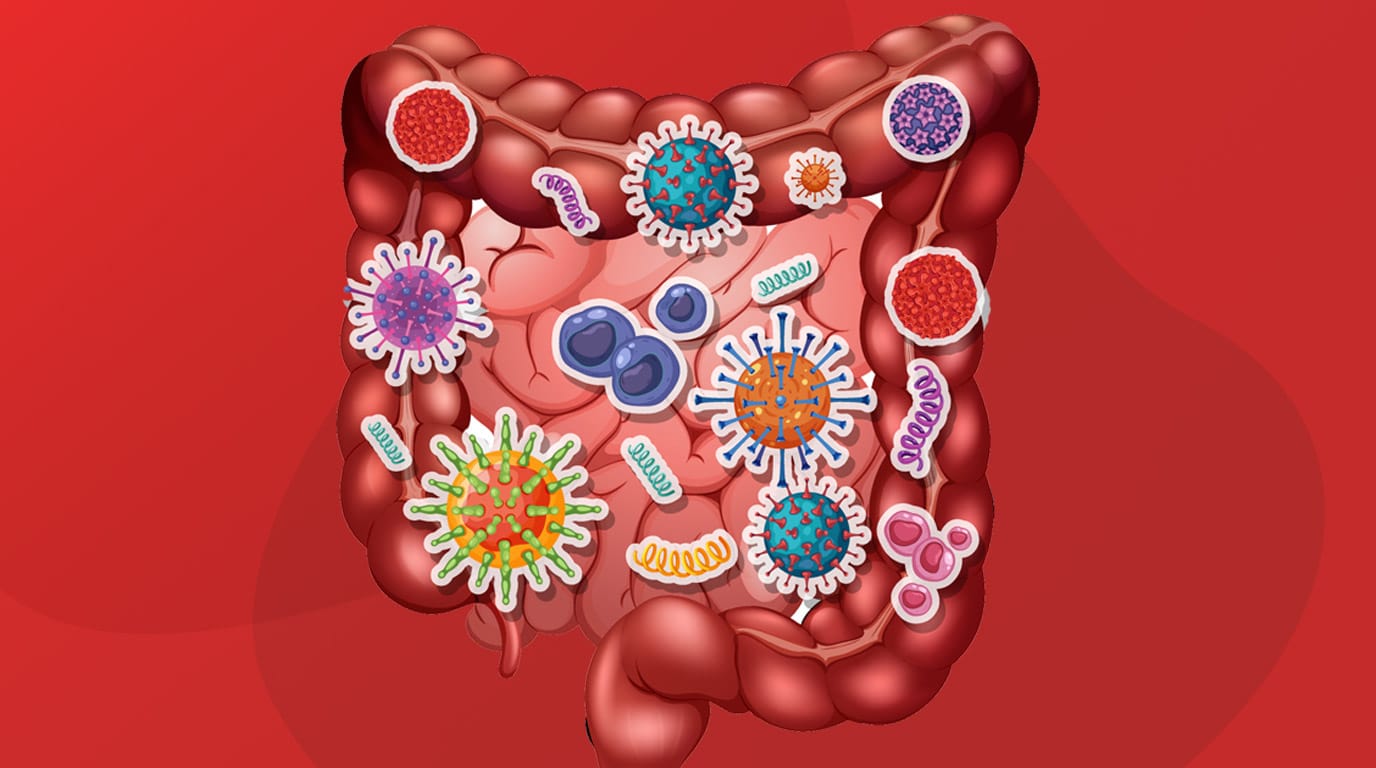 Gut-Driven Kidney Stones