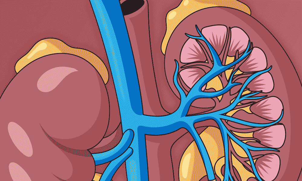 Kidney Stone Stent 411